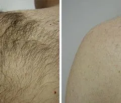 Fotona official shoulder-area hair reduction baseline image; illustrative only, not a Dr Tam Medical Spa patient result