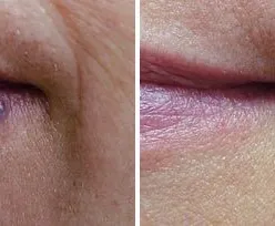 Fotona official hemangioma treatment baseline; illustrative only