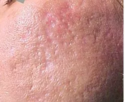 Fotona acne case 2 baseline; illustrative only