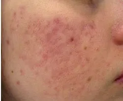 Fotona acne case 4 follow-up; illustrative only