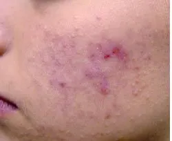Fotona acne case 1 baseline; illustrative only