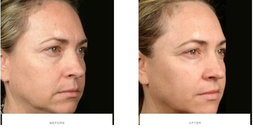 Thermage FLX facial treatment; illustrative image