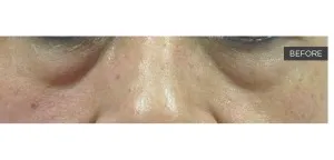 Fotona official SmoothEye Clinical Results case 3, baseline image; illustrative only, not a Dr Tam patient result