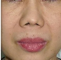 Fotona official Fotona4D clinical result 1 follow-up; illustrative only