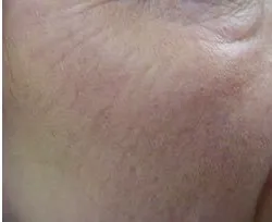 Fotona official Skin Resurfacing Clinical Results case 3, follow-up image; illustrative only, not a Dr Tam patient result
