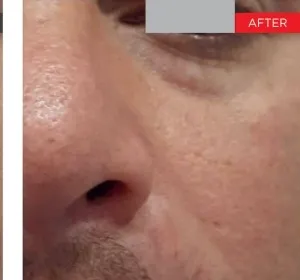 Fotona official Fotona4D clinical result 4 follow-up; illustrative only