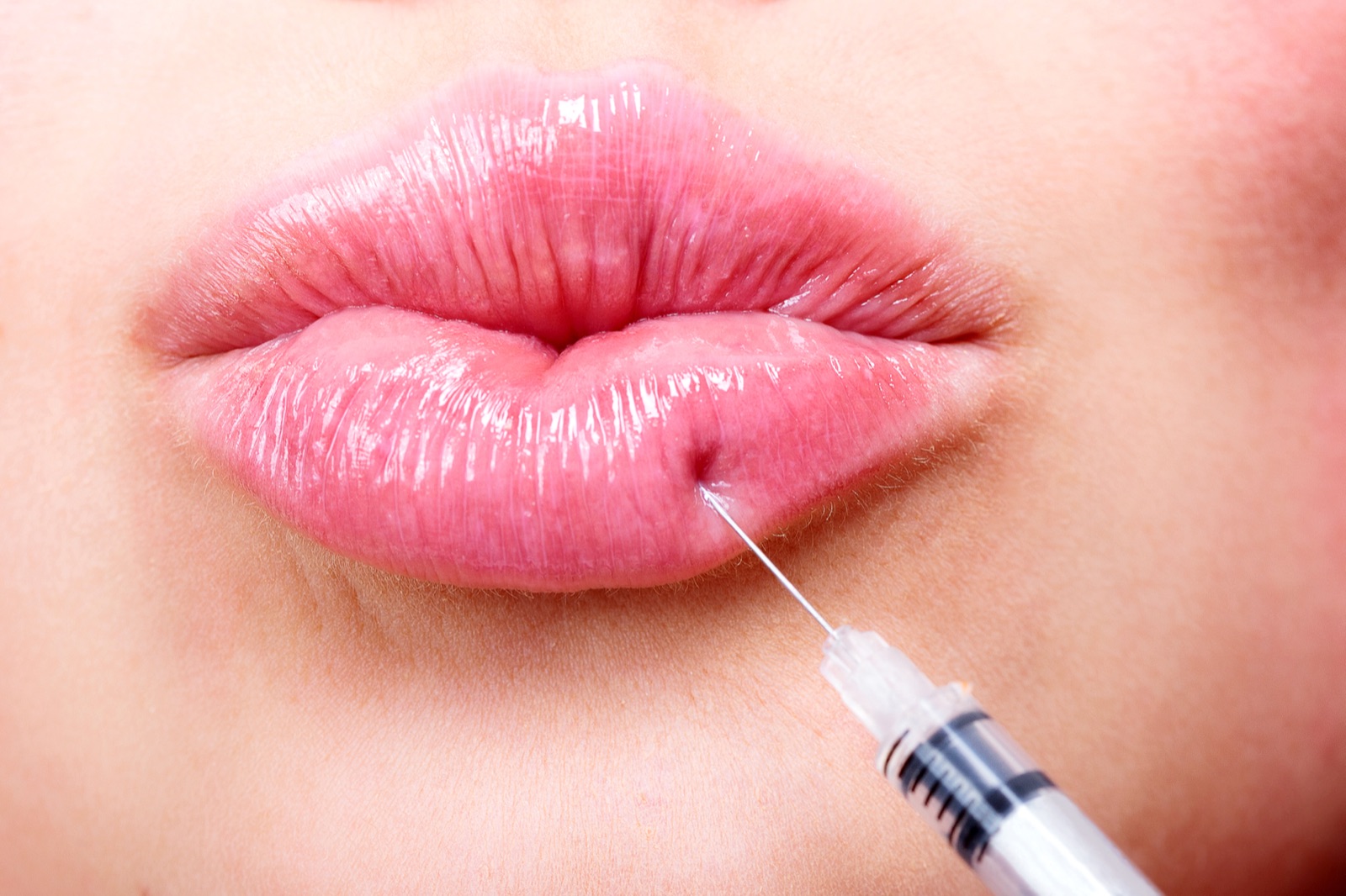 Dermal filler treatment for lips